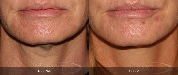 Ultherapy® Before & After Photos Bergen County