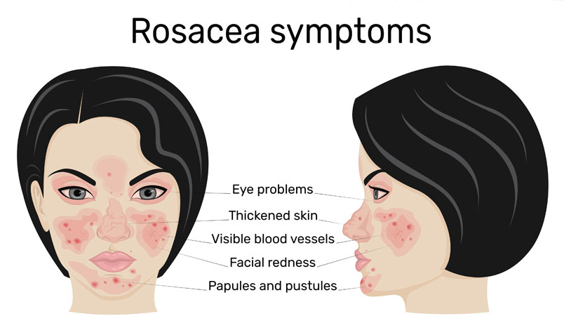 Understanding Two Types Of Rosacea: Skin and the Eyes
