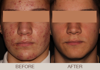 Acne Treatment Gallery