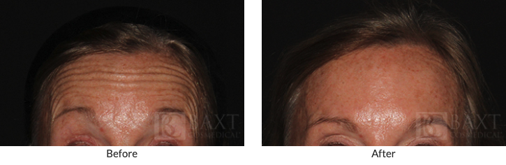 BOTOX® Cosmetic Patient Results