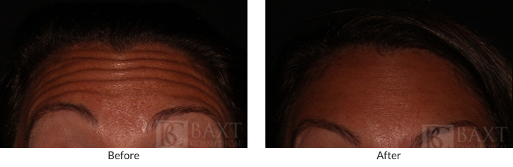 BOTOX® Cosmetic Patient Results