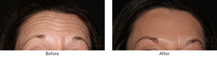 Preventing Forehead Aging in Younger Patients: Before & After