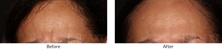 Preventing Forehead Aging in Older Patients: Before & After