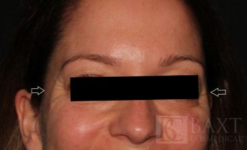 BOTOX® Cosmetic Before - Paramus, NJ