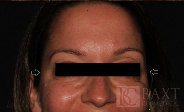 BOTOX® Cosmetic After - Paramus, NJ