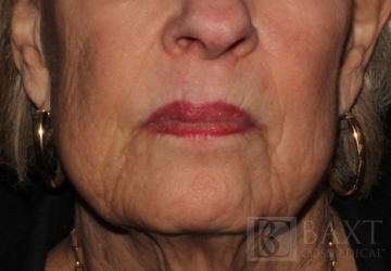 Fillers After - Paramus, NJ