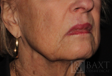 Fillers After - Paramus, NJ